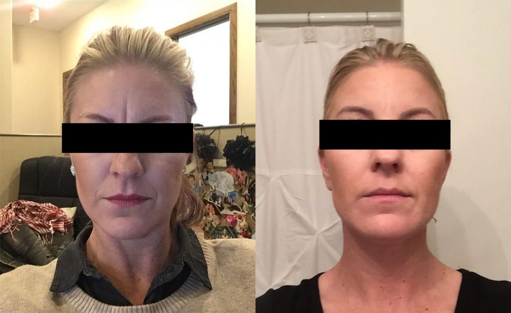 Injectables Before & After #2 before and after