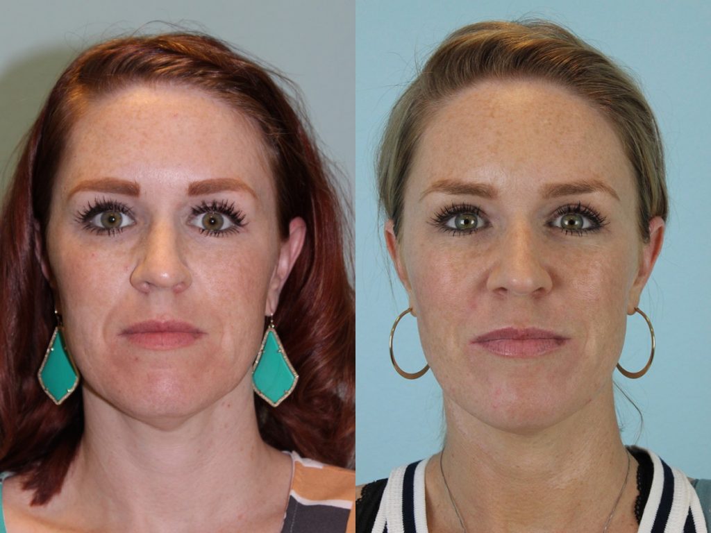 Injectables Before & After #3 before and after