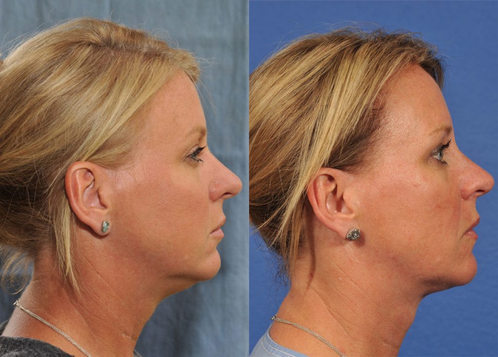 Kybella Before & After #2 before and after