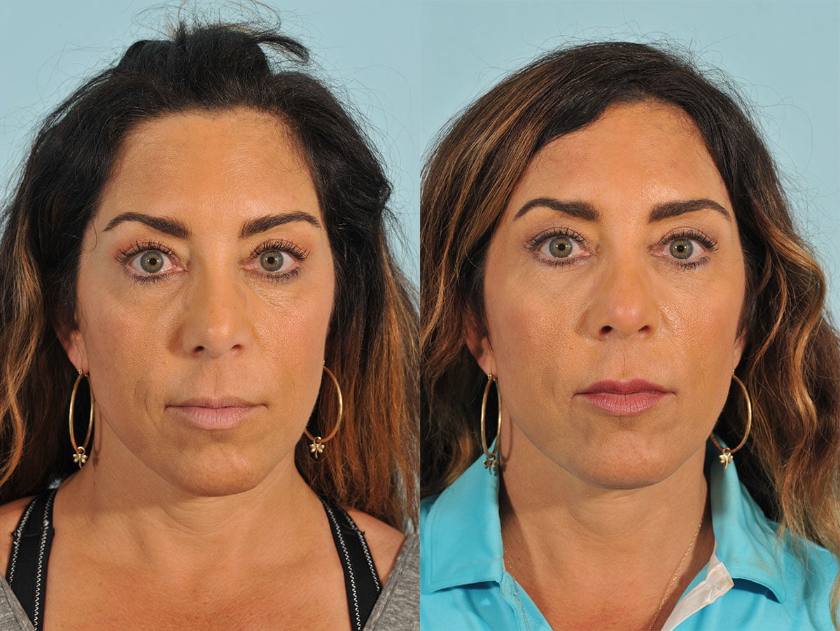 Injectables Before & After #4 image 1