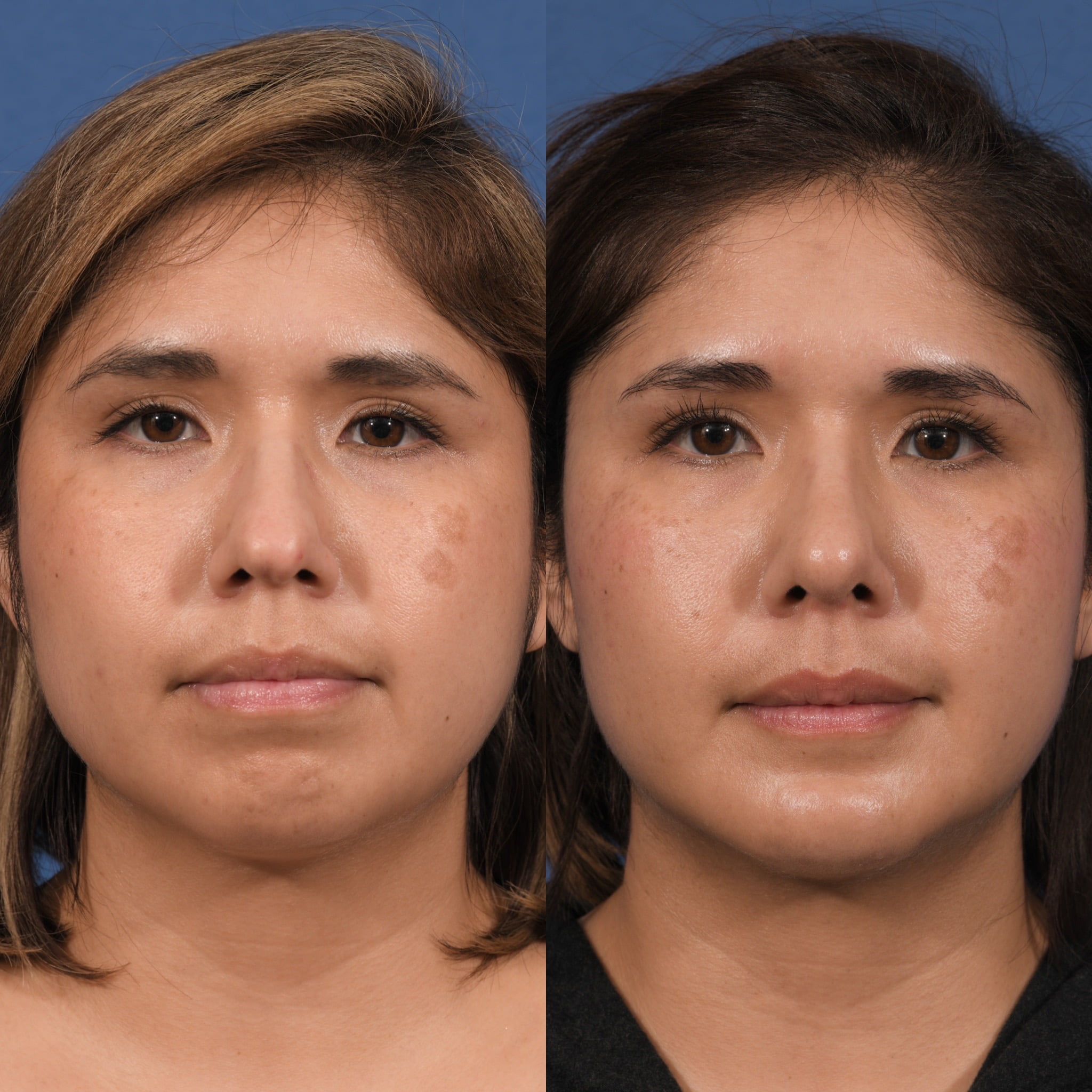 Rhinoplasty & Chin Before & After #1