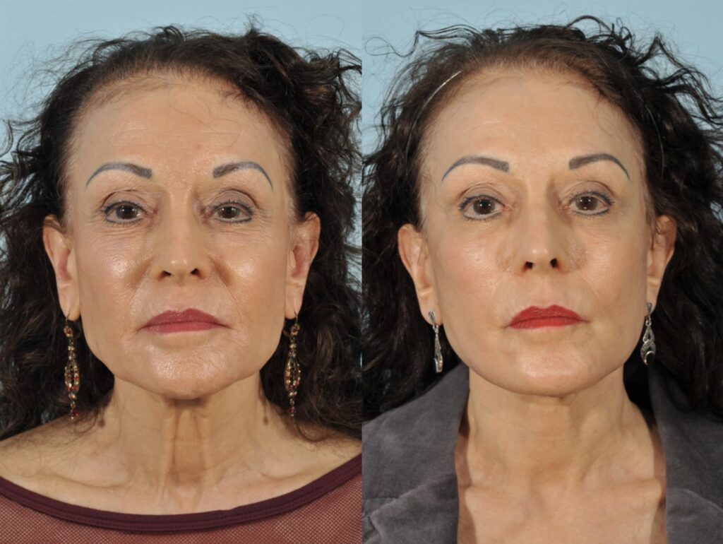 Facelift Before & After #2 before and after