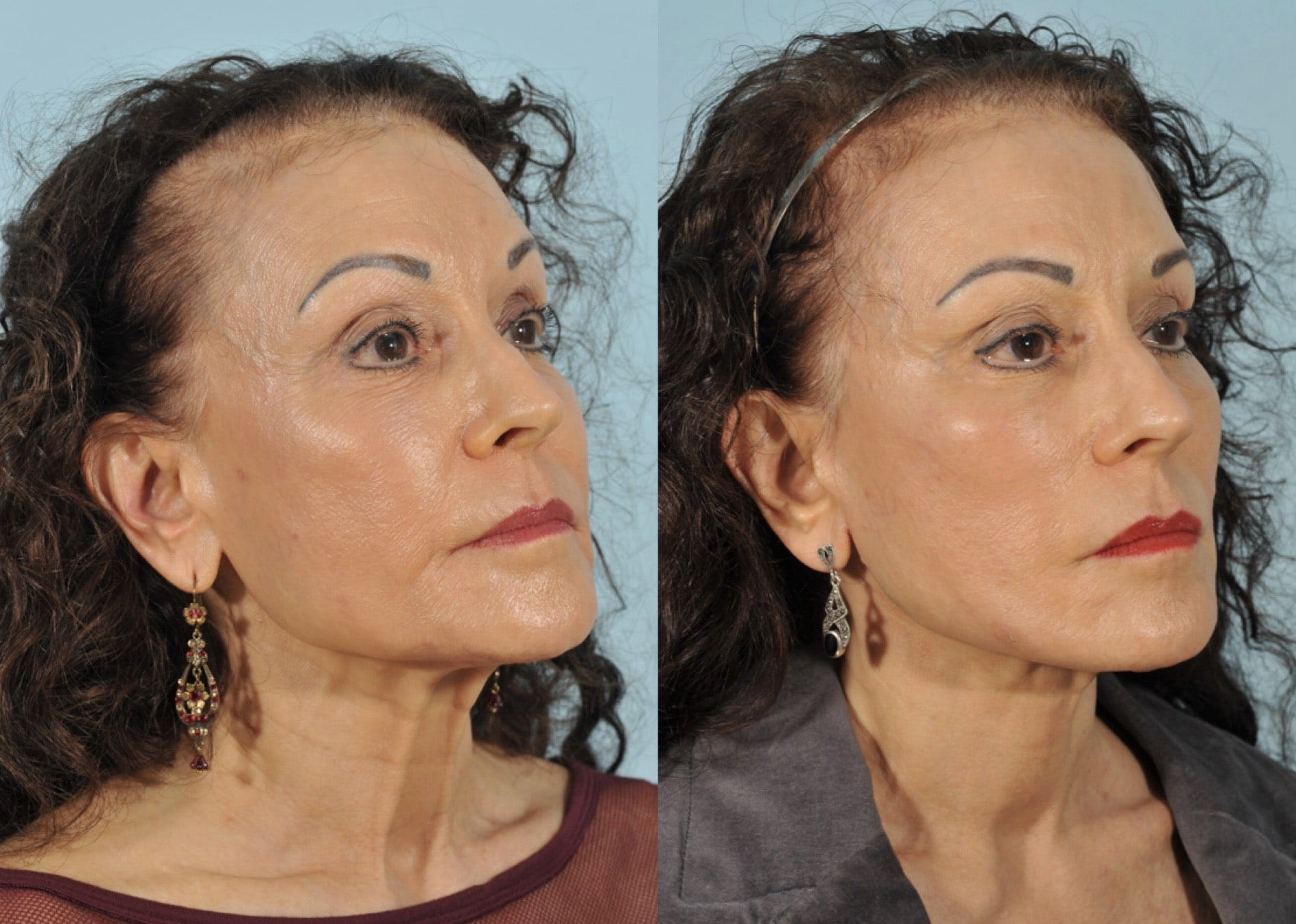 Facelift Before & After #2 image 4