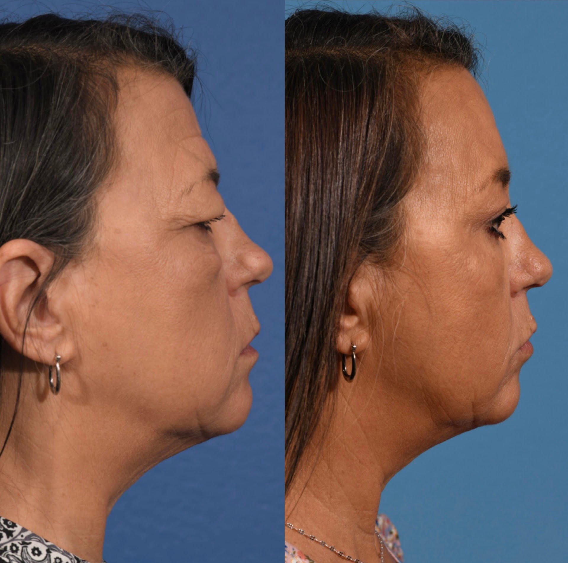 Blepharoplasty Before & After #4