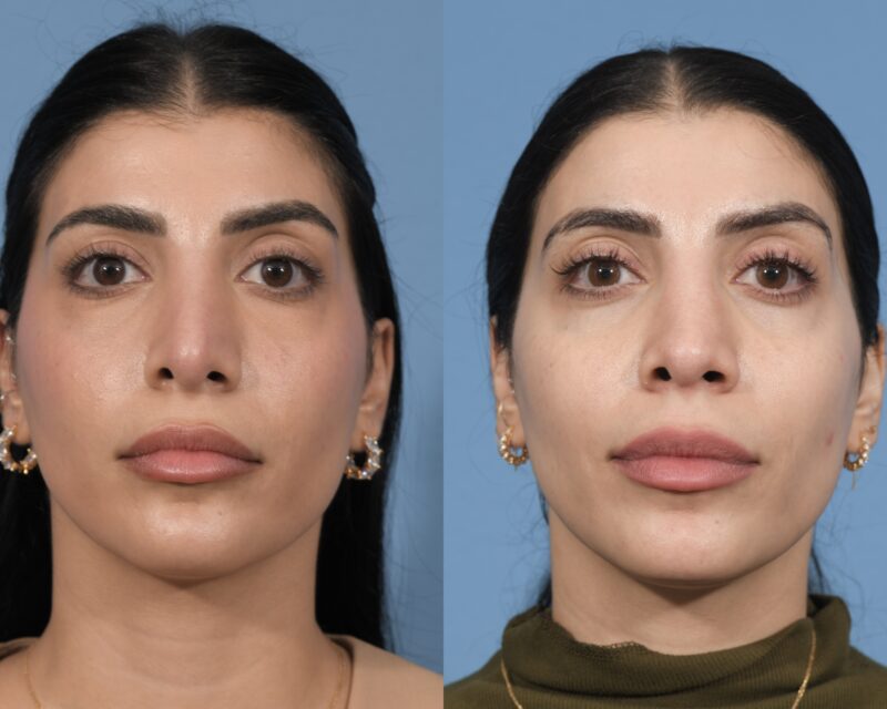 Revision Rhinoplasty Before & After #3